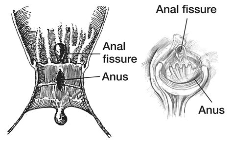 ana butt|Anal fissure .